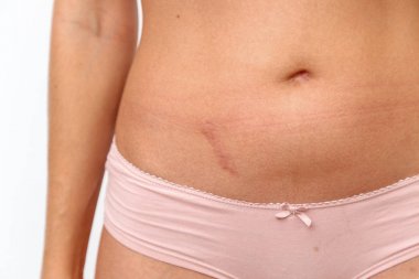 young woman in lingerie shows appendicitis scar on white isolate clipart