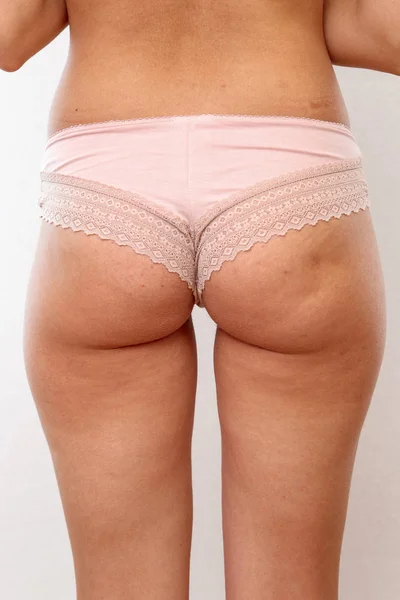 Ung kvinna visar sina skinkor med celluliter och bristningar — Stockfoto