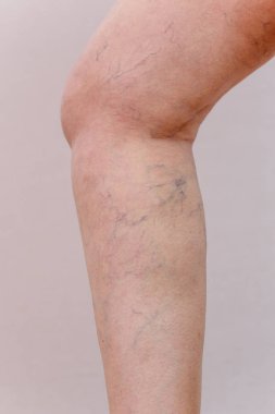 Elderly woman in white panties shows cellulite and varicose veins on a light isolated background. Concept for medicine and cosmetology. clipart