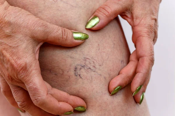 Mujer Edad Avanzada Bragas Blancas Muestra Celulitis Las Venas Varicosas — Foto de Stock