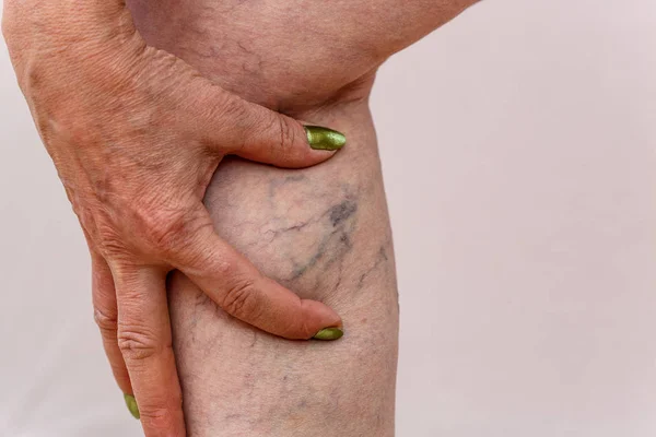 Eine Ältere Frau Weißen Höschen Zeigt Cellulite Und Krampfadern Auf — Stockfoto