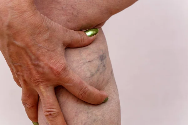Eine Ältere Frau Weißen Höschen Zeigt Cellulite Und Krampfadern Auf — Stockfoto