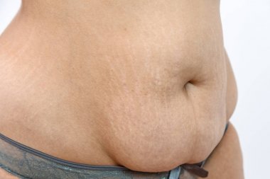 genç bir kilolu kadının çatlakları ile büyük göbek .