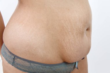 genç bir kilolu kadının çatlakları ile büyük göbek .