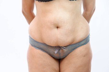 genç bir kilolu kadının çatlakları ile büyük göbek .