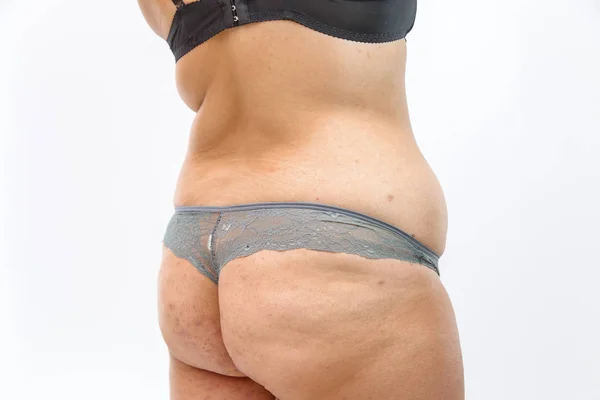 Kroppen av en ung kvinna i underkläder med Stretch Marks och Ove — Stockfoto