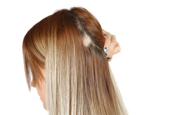 Spot alopesi ile 30 yaşındaki Kafkas kadın, onu kel nokta