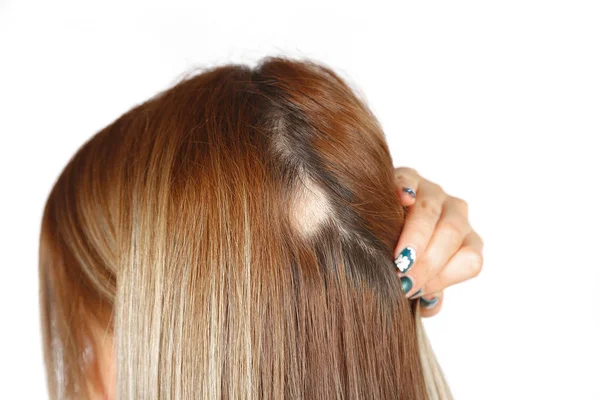 Spot alopesi ile 30 yaşındaki Kafkas kadın, onu kel nokta