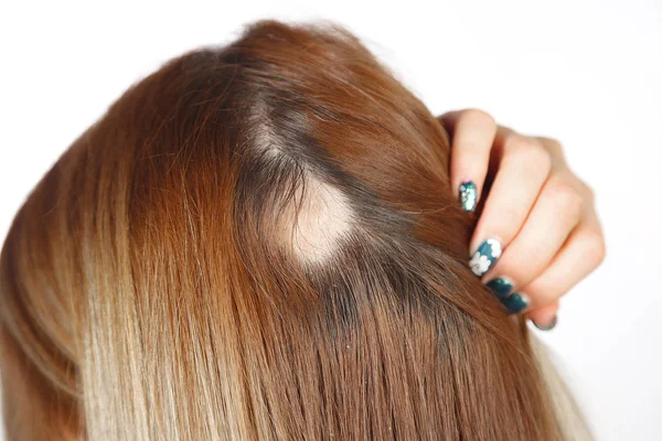 Spot alopesi ile 30 yaşındaki Kafkas kadın, onu kel nokta