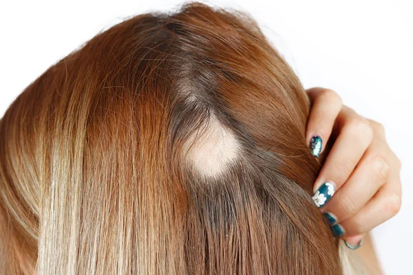 Spot alopesi ile 30 yaşındaki Kafkas kadın, onu kel nokta