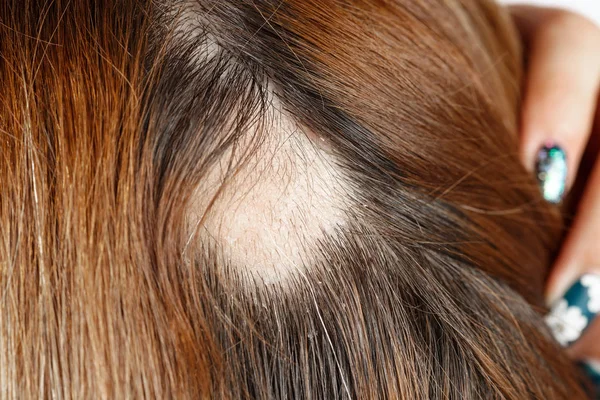 30 éves kaukázusi nő a helyszínen alopecia, kopasz folt rá — Stock Fotó