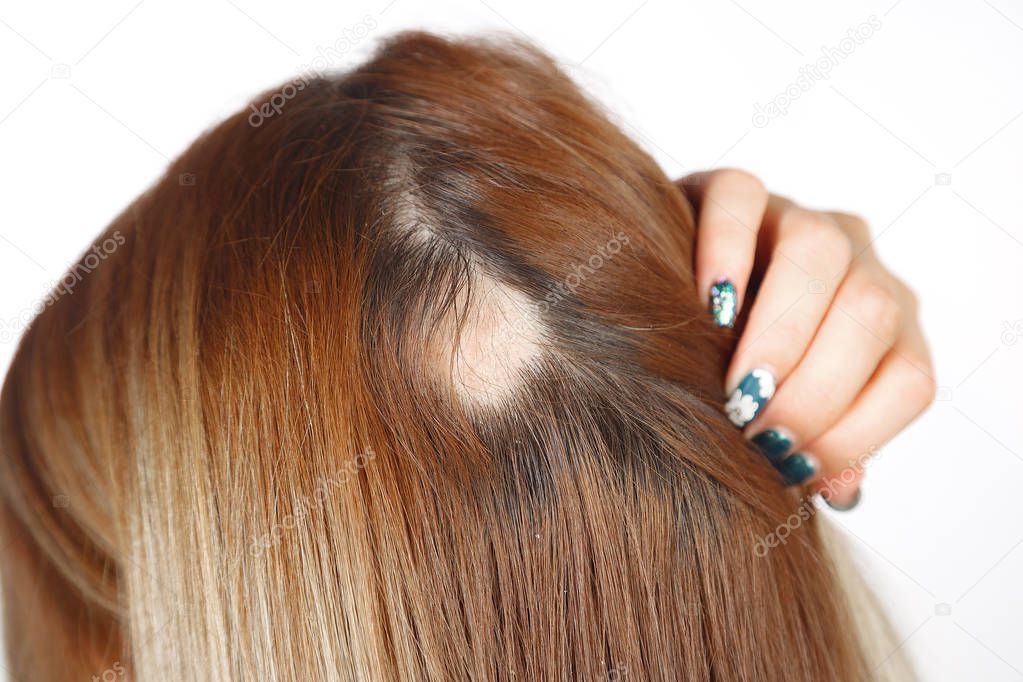 30 year old Caucasian woman with spot alopecia, bald spot on her