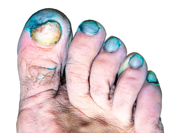 Infecção dos dedos dos pés com um fungo em um fundo branco — Fotografia de Stock