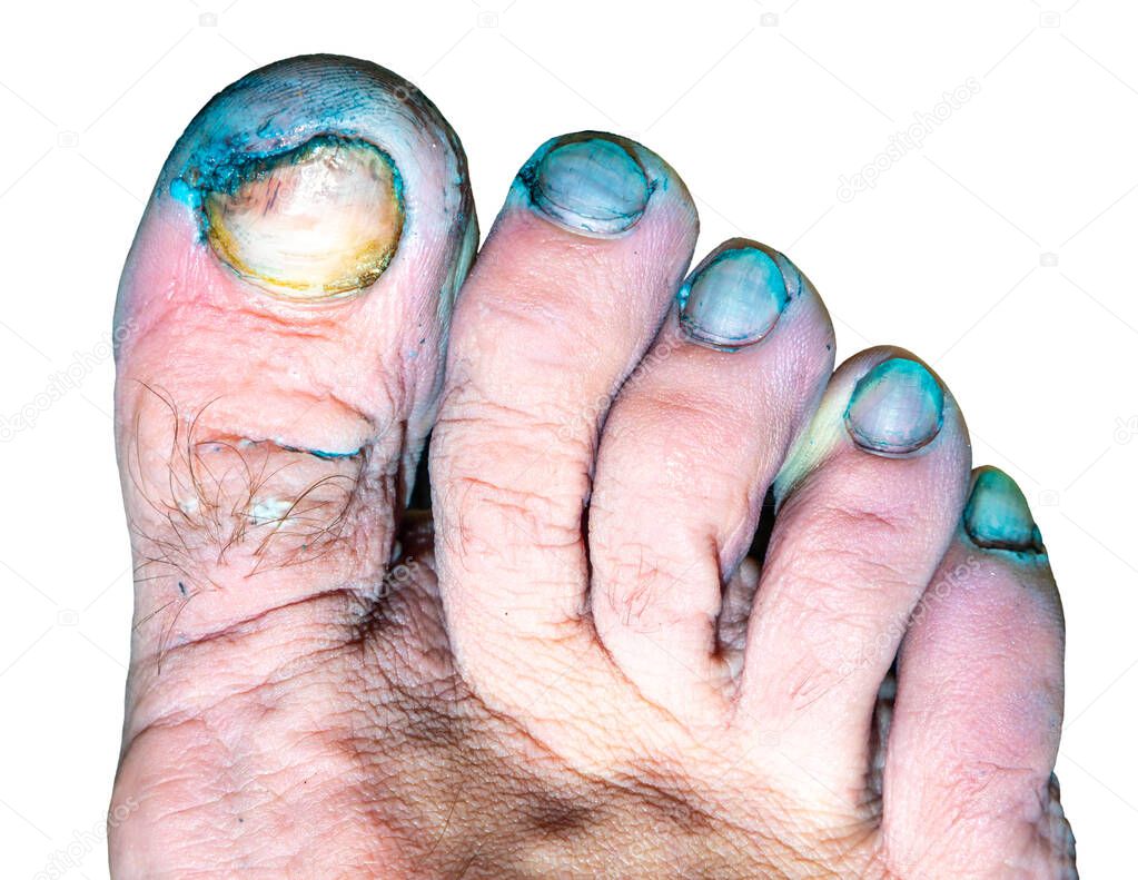 infection of the toes with a fungus on a white background