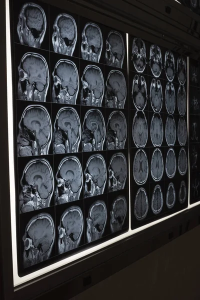 Imagings of MRI of human brain on the light box