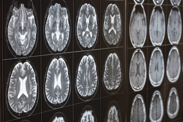 Imágenes Resonancia Magnética Cerebral Humana Caja Luz — Foto de Stock