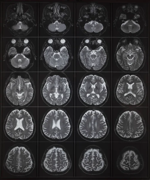 Mri Des Normalen Menschlichen Gehirns Auf Dem Leuchtkasten — Stockfoto