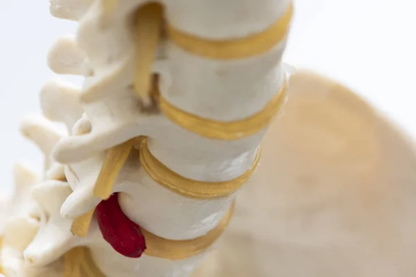 Yakın çekim yapay insan fıtıklaşmış lomber intervertebral disk model görünümü