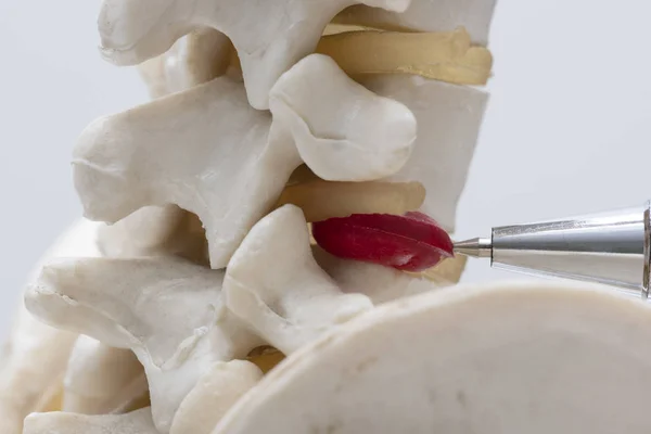 Una Pluma Apuntando Modelo Disco Intervertebral Lumbar Herniado Humano Artificial — Foto de Stock