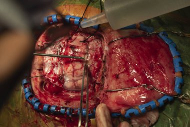 Hemostazın ameliyat odasında kullanarak beyin ameliyatı gerçekleştiren beyin cerrahı