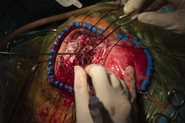 Hemostazın kullanýlýyor ameliyat odasında beyin ameliyatı gerçekleştiren beyin cerrahı