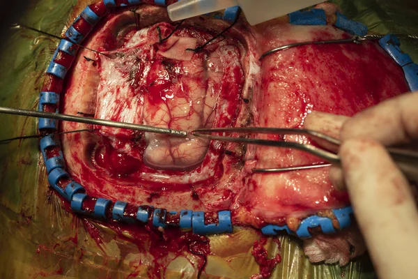Neurochirurgo Che Esegue Intervento Chirurgico Cervello Utilizzando Apparecchiature Emostasi Sala — Foto Stock
