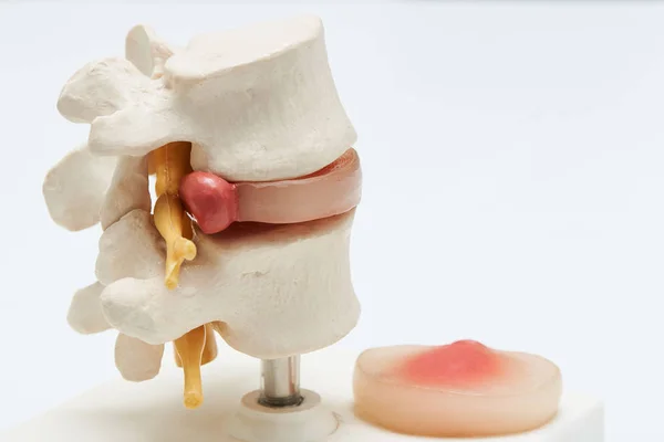医療事務に白い背景の上モデル人工人間の腰椎と椎間板の側面図 — ストック写真