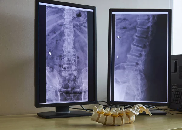 Artificial human lumbar spine model in medical office. Lumbar spine x-rays on computer monitor.