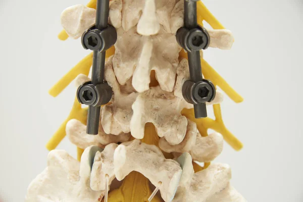 Крупный План Заднего Вида Модель Фиксации Инструмента Поясничного Отдела Позвоночника — стоковое фото