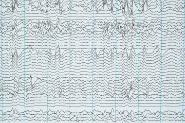 İnsan elektroansefalografi veya Eeg beyin dalgaların görüntüleme