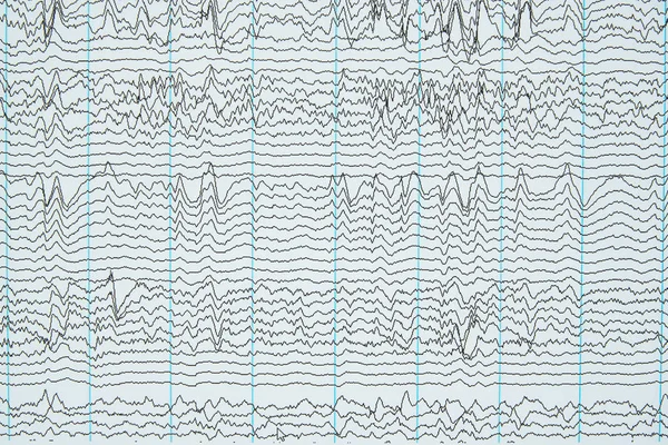 İnsan elektroansefalografi veya Eeg beyin dalgaların görüntüleme