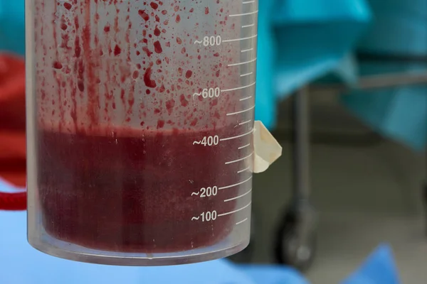 Viel Blut Einem Saugbehälter Während Der Operation Operationssaal — Stockfoto