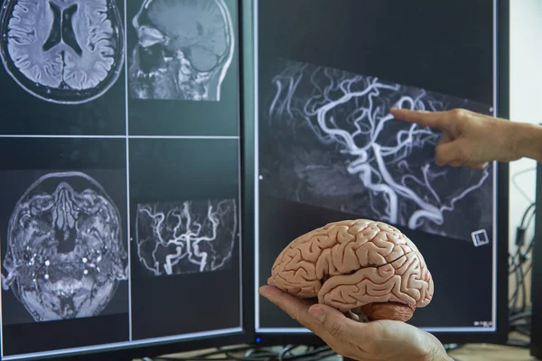 Mänskliga Hjärnan Modell Läkare Neurolog Visar Mrt Hjärnan Datorskärm — Stockfoto