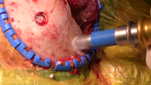 Neurochirurg Chirurgie Uitvoeren Met Behulp Van Apparatuur Gat Menselijke Schedel — Stockvideo