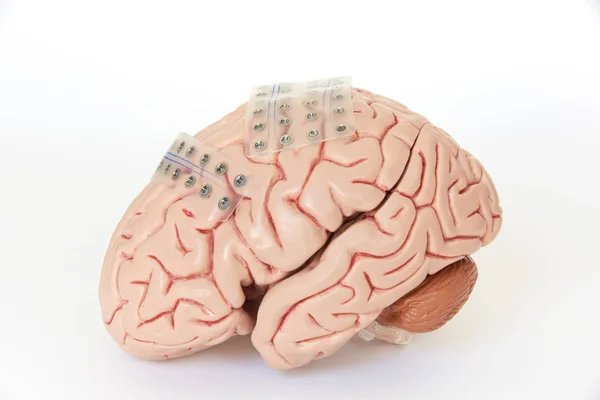Dois Eletrodo Grade Subdural Para Gravação Ondas Cerebrais Eletroencefalografia Córtex — Fotografia de Stock