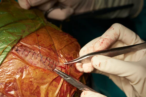 外科医の手術室でのスレッドを保持している看護師のアシスタントで 頭皮の傷を縫合 — ストック写真