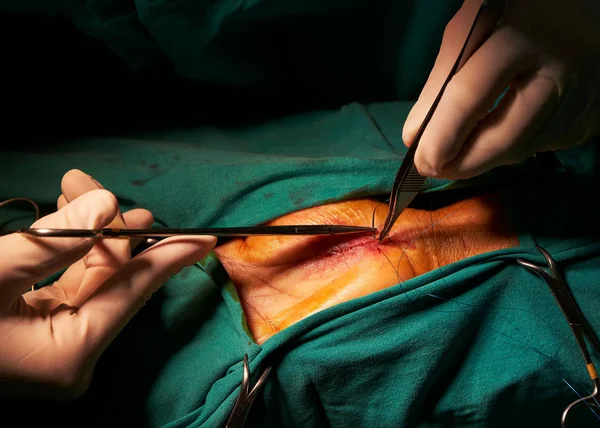 医師針ホルダーを押しながら手術室のステッチの縫合 — ストック写真