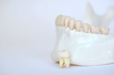 Ayıklanan yaş molar dişi insan çene modeli