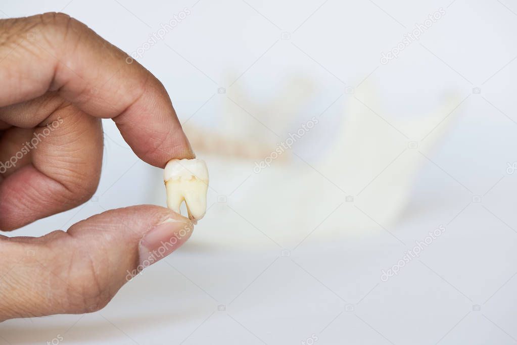Dentist holding an extracted wisdom tooth. Human mandible and teeth on background 