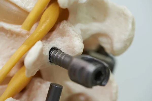 Close-up view of lumbar spine model and instrument fixation — Stock Photo, Image