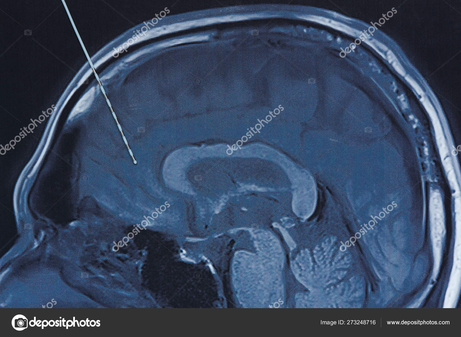 Depth electrode on brain MRI imaging. Stock Photo by ©srikijt 273248716