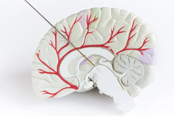 Conceito de registro de ondas cerebrais na cirurgia da doença de Parkinson . — Fotografia de Stock