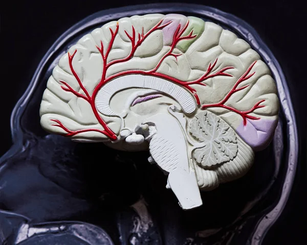 Modelo cerebral y resonancia magnética cerebral — Foto de Stock
