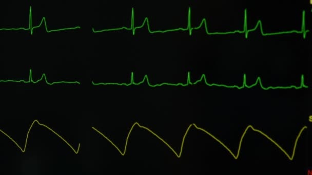 Computer Scherm Met Patiënt Vitale Functies Intensive Care Unit — Stockvideo