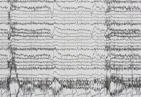 İnsanın elektroensefalografi kaydının görüntülenmesi