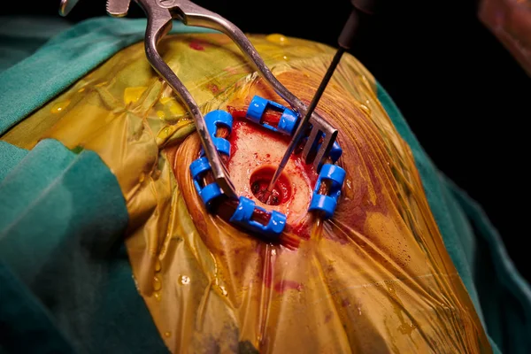 Neurosurgeon inserting needle for brain biosy — ストック写真