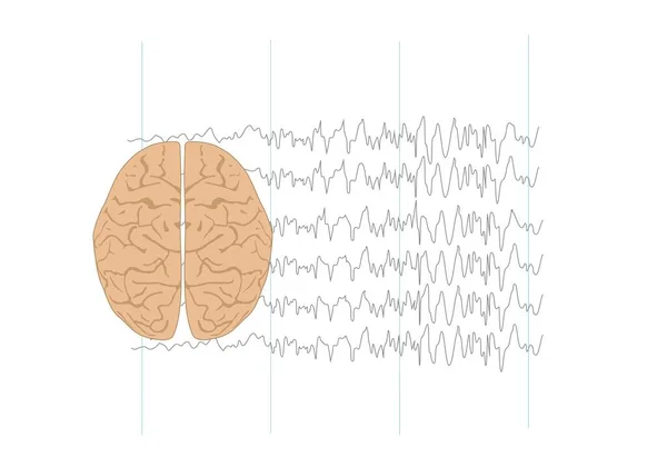 Ilustración Del Cerebro Ondas Cerebrales Anormales — Vector de stock