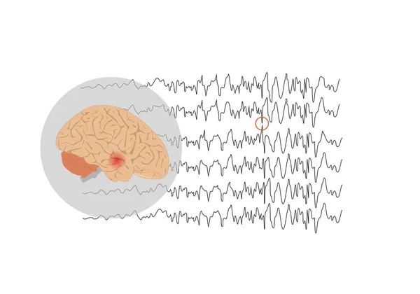 Convulsiones Focales Procedentes Del Lóbulo Temporal — Archivo Imágenes Vectoriales