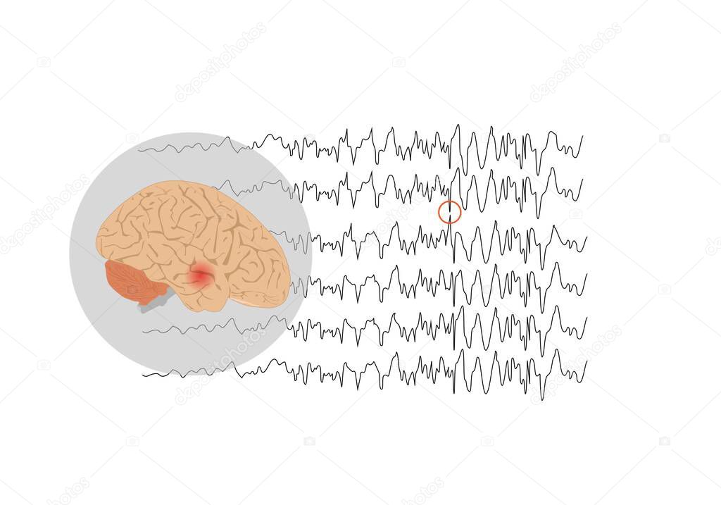 Focal seizure originating from temporal lobe