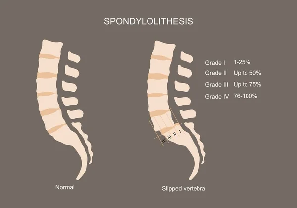 腰椎とスポンジオリシスのベクトル図 — ストックベクタ